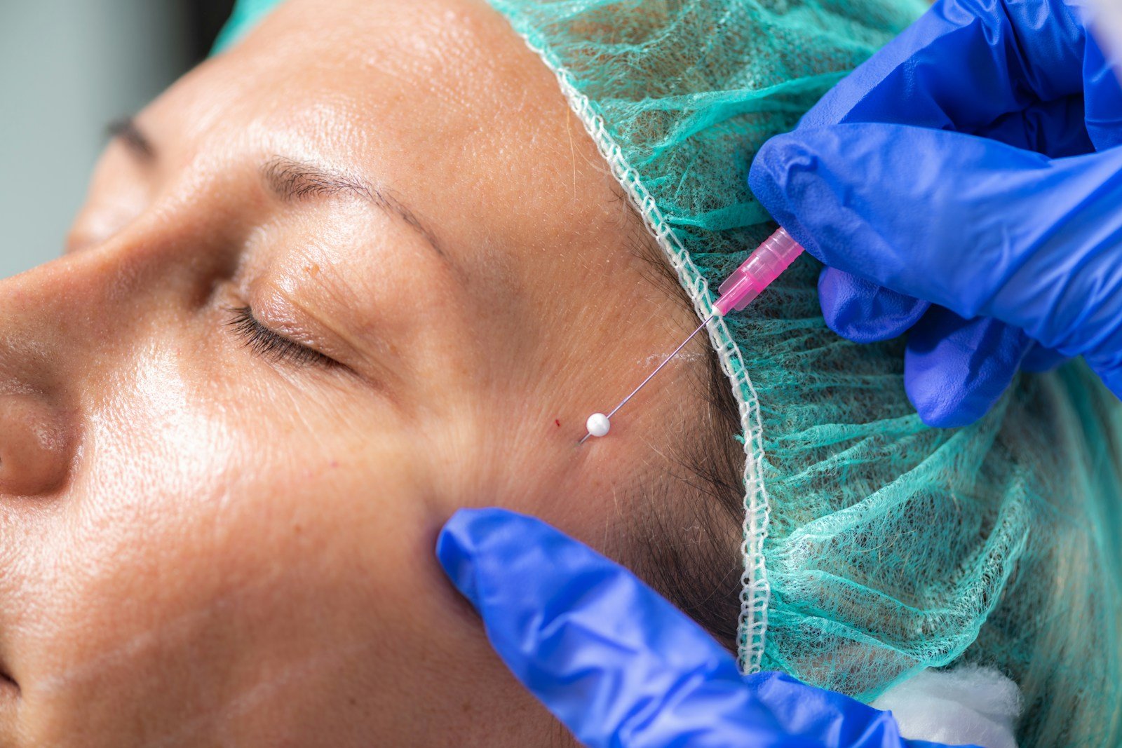 A woman receiving a thread lift procedure on her face